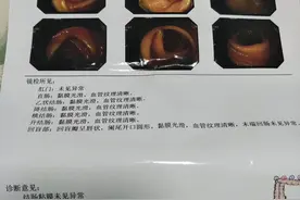 我第一次肠镜检查经历图片