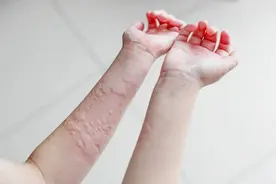 荨麻疹反反复复，这个秘方是真的管用！图片
