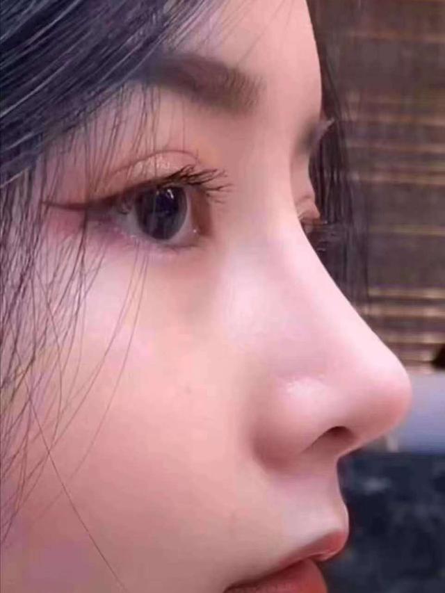 如何让鼻梁变高的日常方法,隆鼻前必看篇:鼻子做得过高反而丑,而且假!
