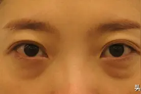 我发现了“一次性解决泪沟”的办法，眼袋重、泪沟深的存下吧！图片