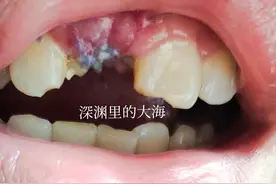 种植牙术后17天真实体验图片