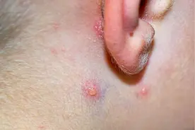 有一种会动的“瘤”，叫毛母质瘤图片