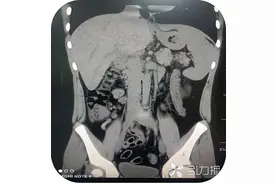 苏州首例！不开刀、不流血治疗儿童阑尾炎图片