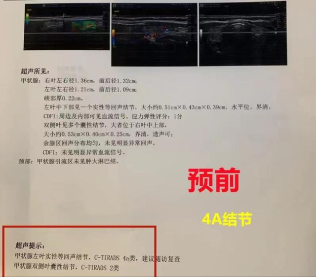 甲状腺结节4a已经20年了 甲状腺结节4a已经20年了正常吗