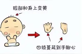 婴儿黄疸多久会消退？图片