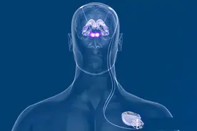 DBS在帕金森病及梅杰综合征扭转痉挛等肌张力障碍的临床治疗效果图片