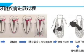 为什么根管治疗后要戴牙套？图片