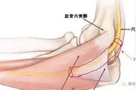 手指麻木别大意，警惕肘管综合征图片