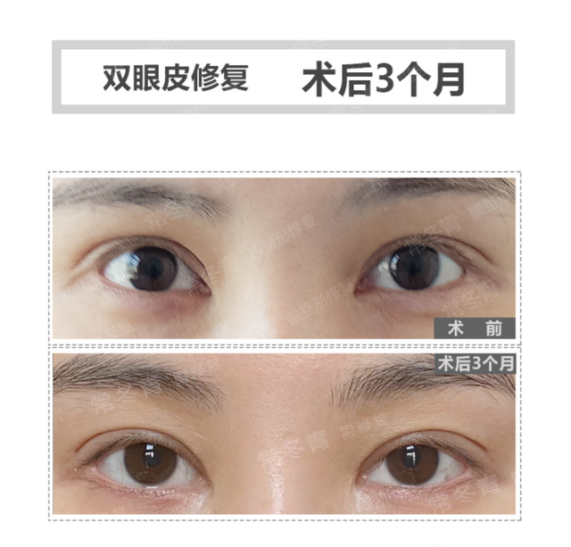什么是翘睫术双眼皮 - 冷求网