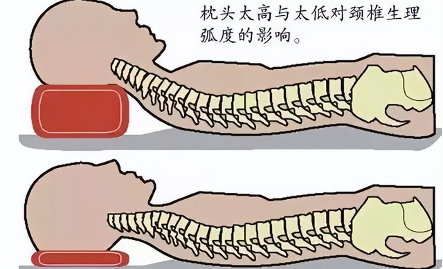颈部脊椎突出怎么办