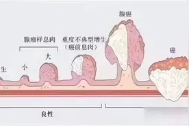 你了解肠息肉吗？从息肉到癌，仅仅只差有没有做肠镜图片