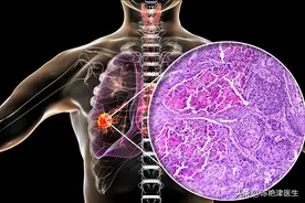 夺去赵忠祥生命的“鳞状细胞癌”，听起来陌生，实际上却很常见图片