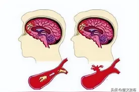 冬天容易导致脑血栓，家里有老人要小心图片