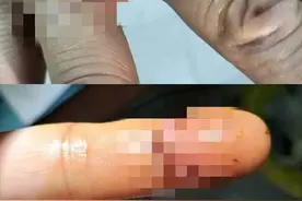 厦门：洗个茶杯，伤得手指要缝针图片