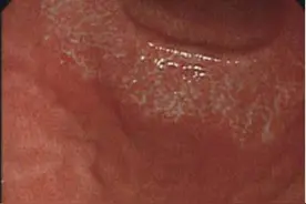 萎缩性胃炎C1是什么意思？严重吗？图片