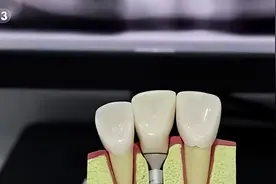 4万元项目只要9千多元！北京种植牙价格将大幅降低…图片