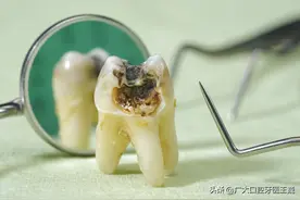 不痛不用拔？这些残根危害可不小，严重要截骨图片