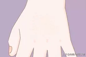 玩完沙子满手起泡？宝妈们注意了，这是沙土性皮炎图片