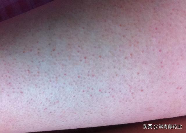 胳膊突然摸起来有鸡皮肤