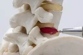 腰椎间盘突出了，怎么治好得快？医生劝人别轻易开刀图片