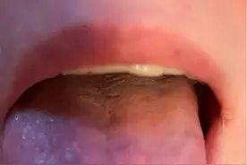 头痛，车祸后遗症-脖子痛的治疗——黄贵生老师治疗案例图片