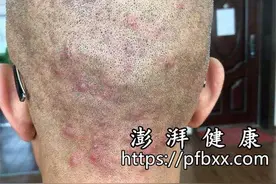 脖子后面长痘痘是什么原因造成的一碰就疼图片