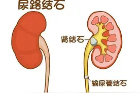 什么是输尿管结石？输尿管结石又该如何治疗？医生告诉您图片