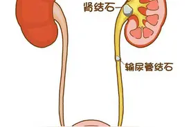 什么是输尿管结石？输尿管结石又该如何治疗？医生告诉您图片