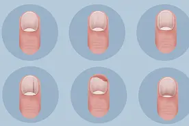 再三提醒：指甲出现2种变化，别轻视了，或是癌症给的警告图片