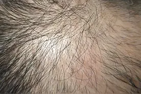 米诺地尔治疗秃顶是不是有效，看我的图片