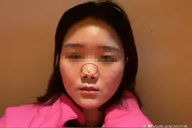 四川一女子上海取肋骨做隆鼻手术自称遭毁容，查出重度抑郁，司法鉴定显示医方最高担责8.5成，她获赔7万余元图片