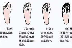 警惕烂脚！糖尿病足早期的4个迹象图片