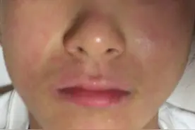 敏感肌泛红修复过程25天全记录，前后变化效果很惊艳图片