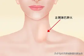 颈部淋巴结，如何消除？图片