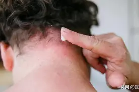 几块钱一支的红霉素软膏：不能长期使用！对这5种病才有效！图片