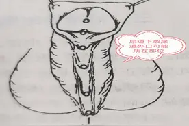 正视孩子不完美 莫让含羞成憾事——关注尿道下裂图片