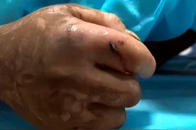 被咬后出现严重肾衰，人称“老婆改嫁蛇”，圆斑蝰到底多缺德？图片