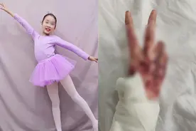 70天经历4次植皮，烧伤女孩亮出胜利手势图片