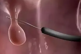 三种息肉一定要及时切除，最短五年就会变成恶性肿瘤！是真的吗图片