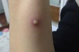 皮肤出现大红包，又硬又疼怎么办？医生教你的小妙招，仅需几块钱图片