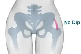 很多女性腿粗屁股大是怎么回事？图片