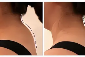 脖子后面的“富贵包”，究竟是怎么长出来的？4招教你科学缓解图片