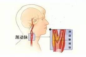 颈动脉有斑块，会出现哪些症状？应该如何治疗？医生讲解图片