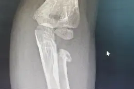 孩子贪玩致胳膊骨折 市医院微创治疗3天出院图片