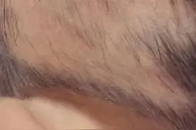 孩子掉发斑秃，用了两种药半年痊愈图片