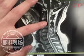 男子颈脖酸痛，常用木棍敲打！医生提醒：小心，可能瘫痪！图片