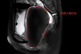 12岁女孩腹痛难忍 原是“处女膜闭锁”惹的祸图片