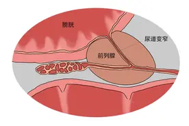 多吃大蒜能杀菌消炎？前列腺炎患者吃了2个月，结果怎么样了？图片