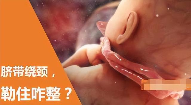 胎儿脐带绕颈三周怎么办