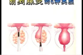 前列腺炎的6种类型，及对症方法图片